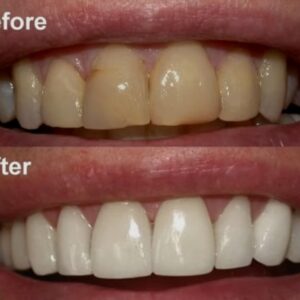 Heavy Stain removing treatment