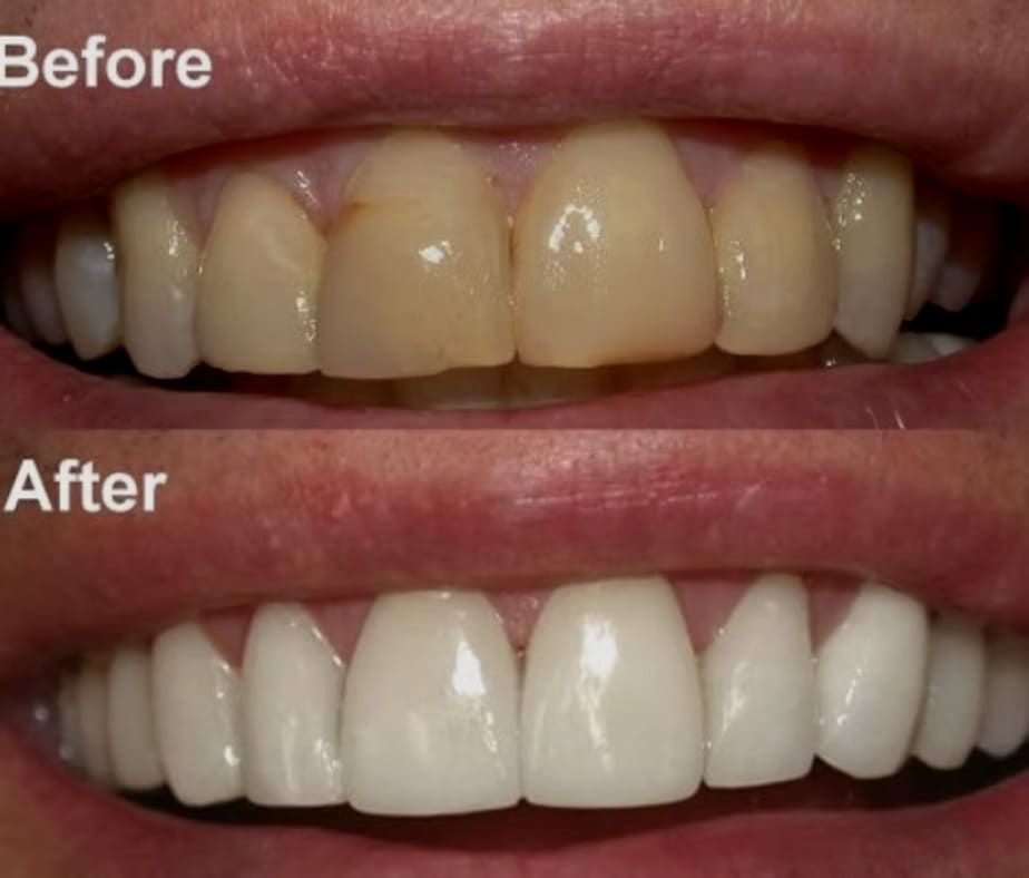 Heavy Stain removing treatment