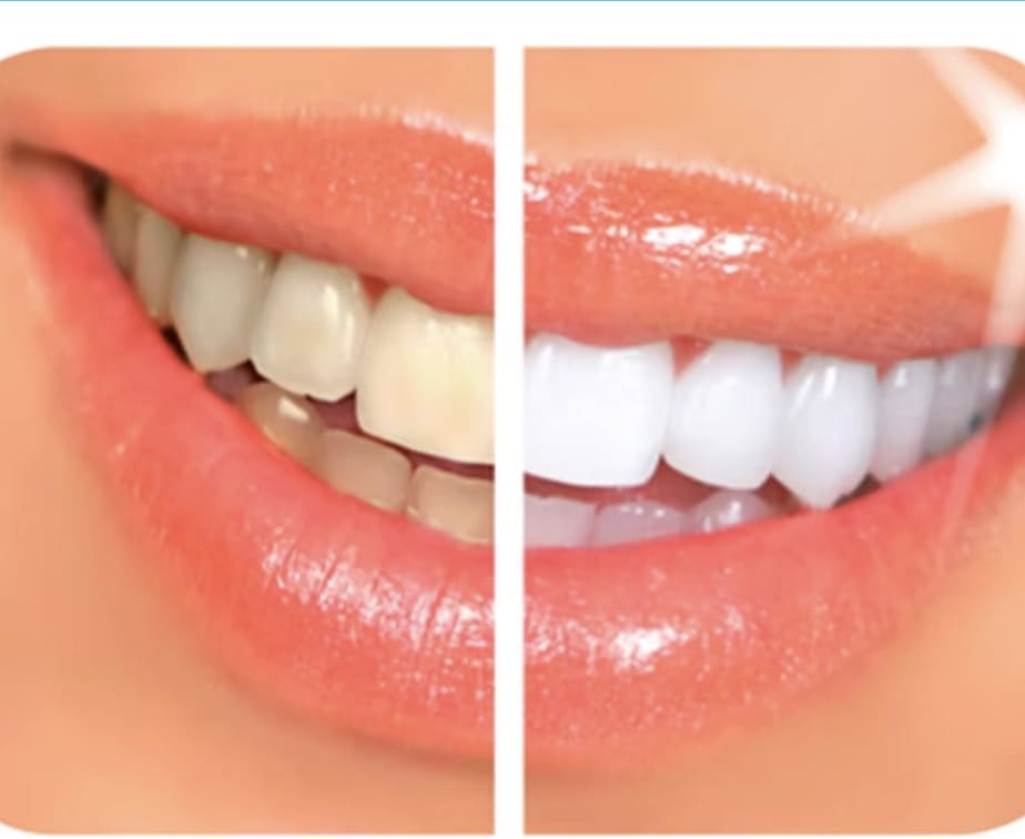 Two people Smile whiter Treatment
