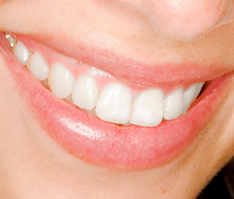 1 hour smile whiter Treatment